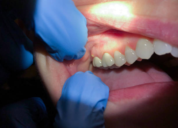Best Emergency Wisdom Teeth Removal in Nederland, CO